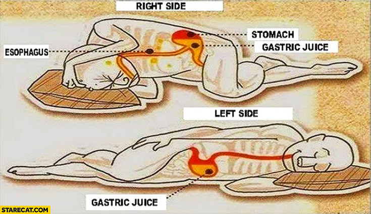 Sleeping on the left side vs right side gastric juice stomach esophagus