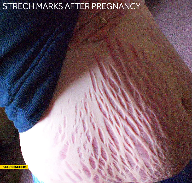 Strech marks after pregnancy