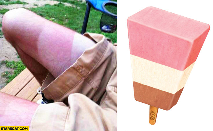 Sunburn tan like ice cream